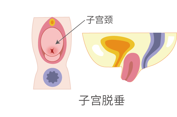 盆腔器官脱垂与子宫位置与有什么关系？如何治疗？