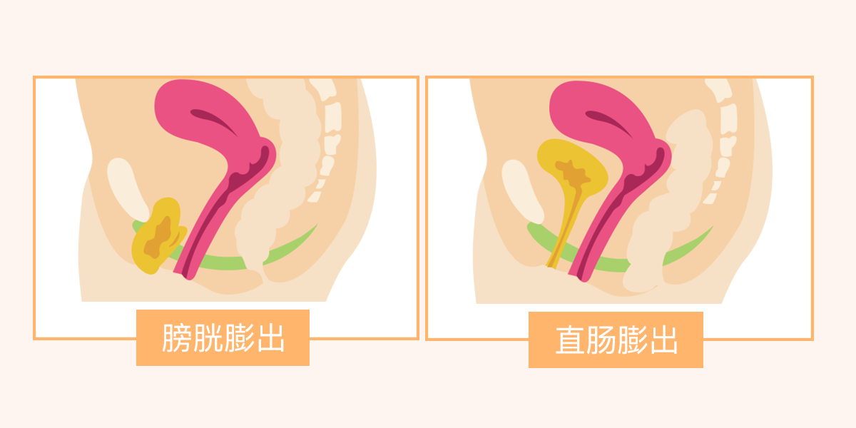 为什么产后下面会下垂？日常生活中应该要注意这3种情况(图1)